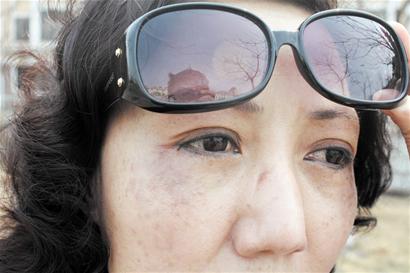 青島女子美容后鼻子跑偏 經(jīng)常從噩夢中驚醒