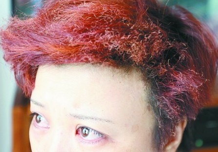張女士的頭發(fā)、眉毛被燒。