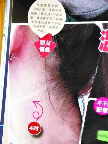 溫嘉蓉展示傷口。