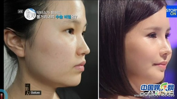 多圖劇透韓國整容節(jié)目《LET 美人》近幾期，最愛小V臉，人瘦就能美