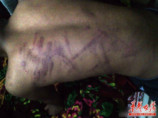網(wǎng)曝云南省富源縣一名老師持續(xù)4小時(shí)體罰學(xué)生，期間打斷5根電線。（圖為被體罰學(xué)生）網(wǎng)絡(luò)截圖
