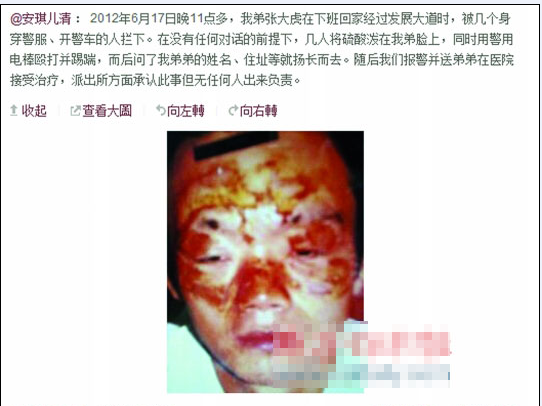 張大虎的姐姐將弟弟面部燒傷一事發(fā)上微博，引發(fā)網(wǎng)友廣泛關(guān)注。
